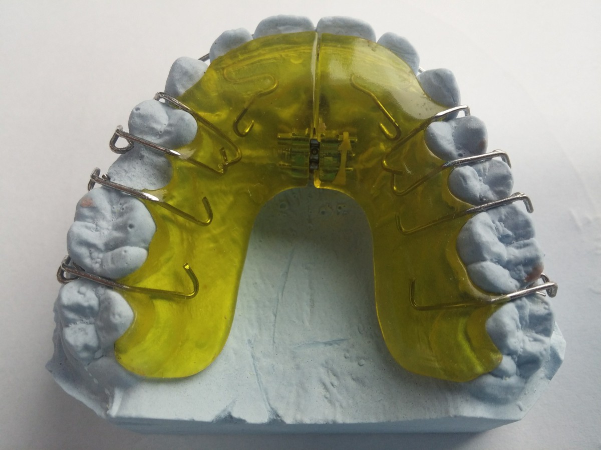 Поставили пластину на зубы. Съемный одночелюстной ортодонтический аппарат. Ортодонтическая пластинка (с использования винта Бертони). Аппарат пендулум ортодонтия. Ортодонтический аппарат Макнамара.